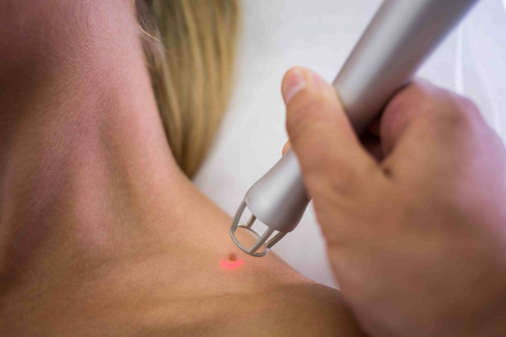 dermatologist removing mole from womans shoulder 1 1024x683 1