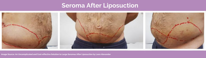 Seroma lipo