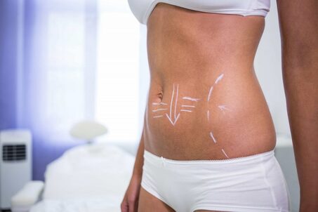 female body with drawing arrows abdomen liposuction cellulite removal 1 1024x683 1