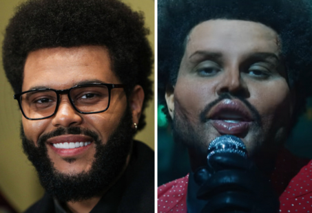 the weeknd plastic surgery
