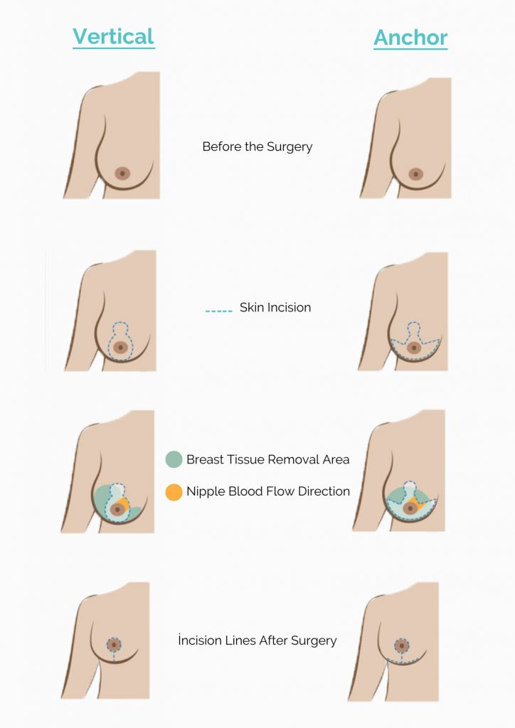 Breast Reduction Techniques Vertical Anchor