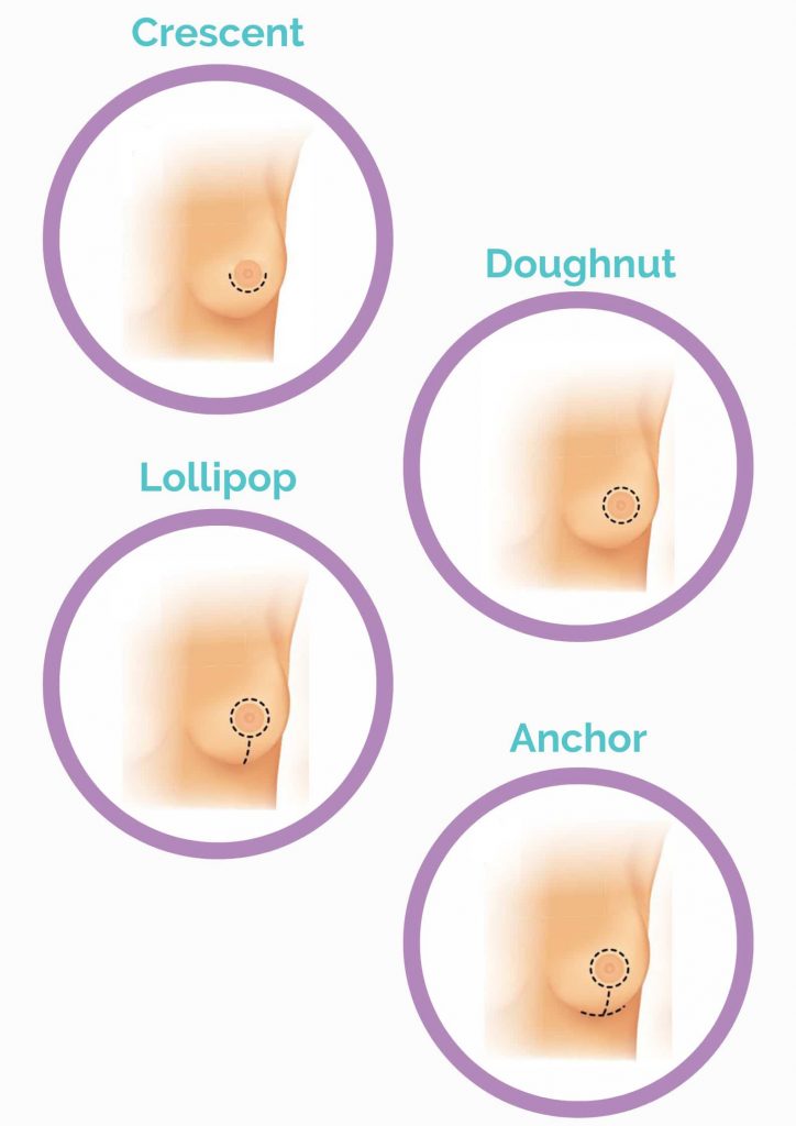 Breast Uplift Incisions