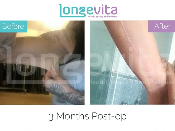 arm lift turkey before after 1 670x500 2