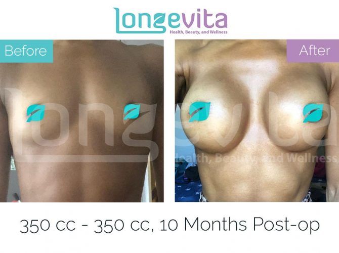 breast enlargement turkey before after 24 670x500 1