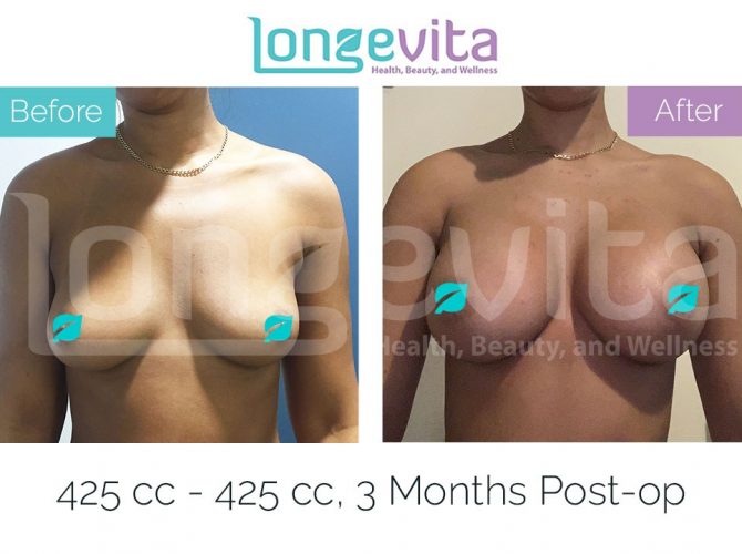 breast enlargement turkey before after 25 670x500 1
