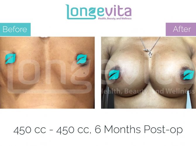 breast enlargement turkey before after 27 670x500 1