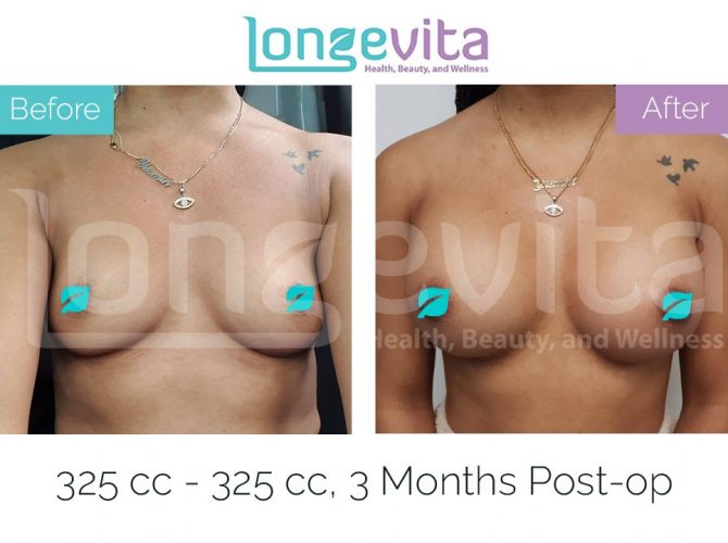 breast enlargement turkey before after 28 670x500 1