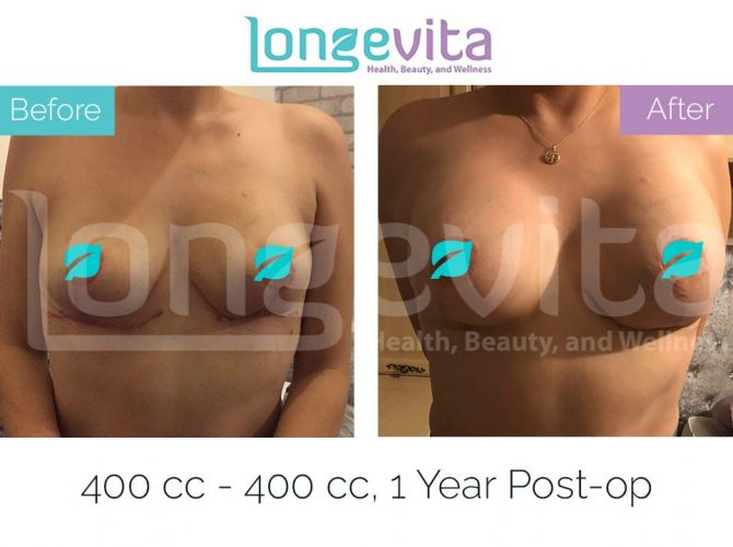 breast implant replacement turkey before after 2 670x500 1