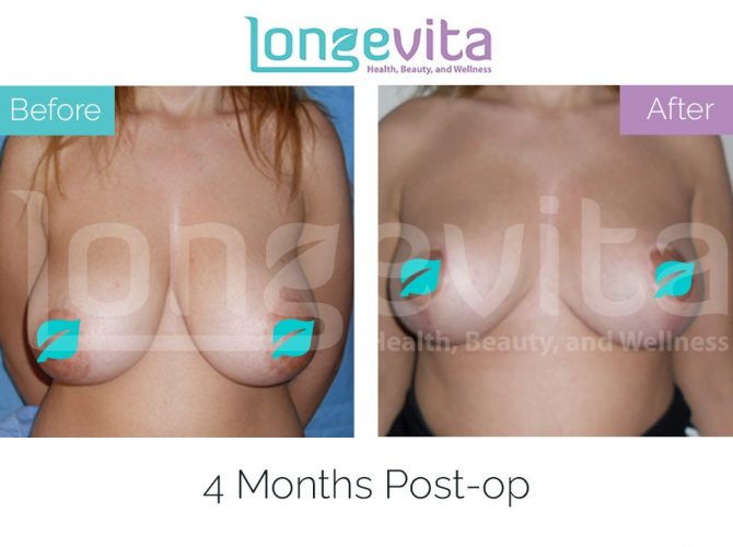 breast lift turkey before after 14 670x500 1
