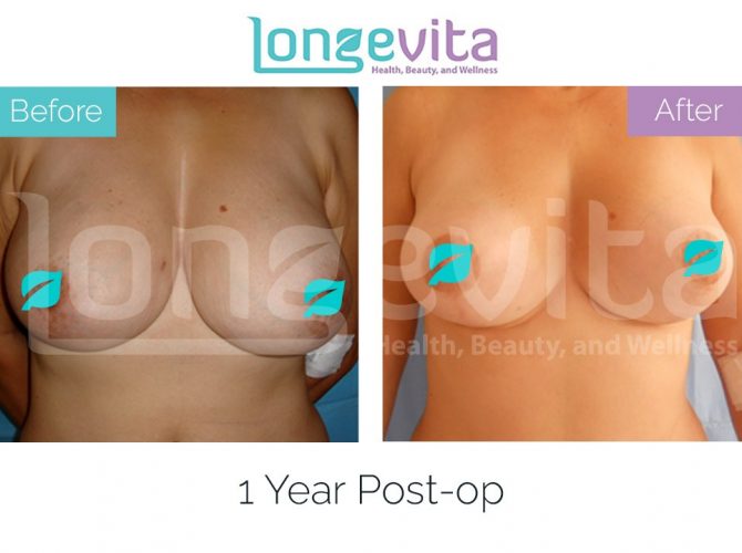 breast lift turkey before after 19 670x500 1