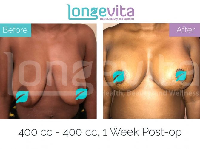 breast lift with implants turkey before after 2 670x500 1