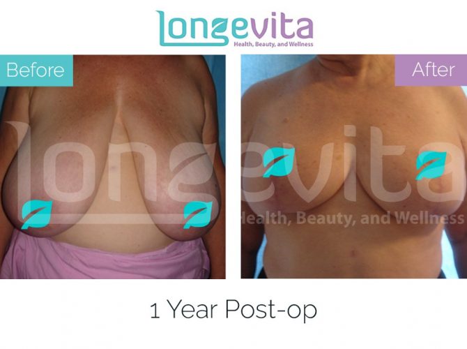 breast reduction turkey before after 6 670x500 1