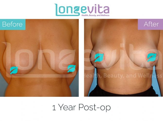 breast reduction turkey before after 7 670x500 1