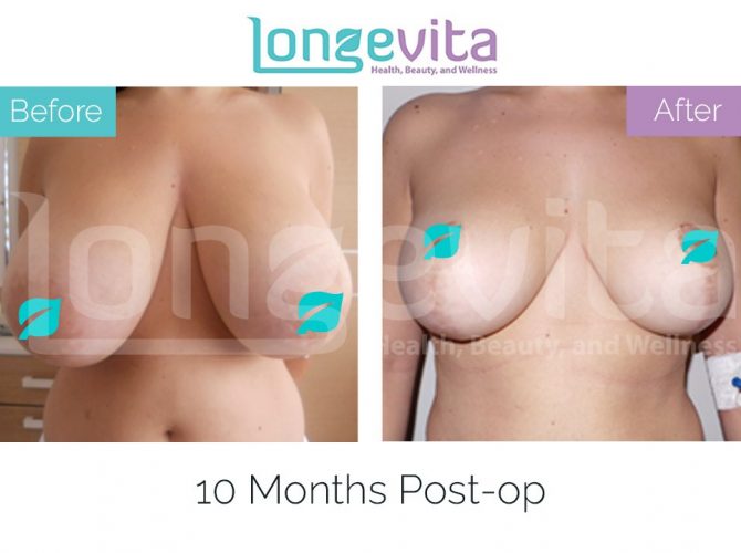 breast reduction turkey before after 8 670x500 1
