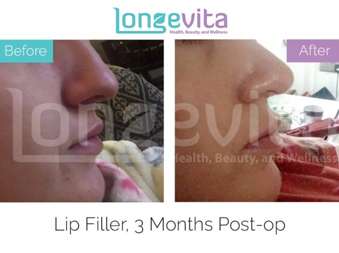 lip fillers turkey before after 2 670x500 1