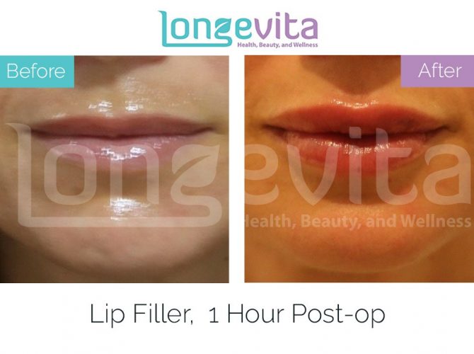 lip fillers turkey before after 4 670x500 1