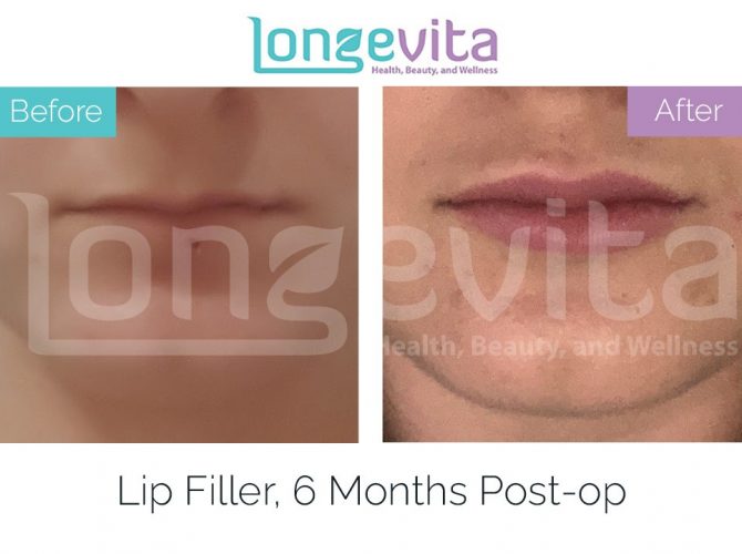 lip fillers turkey before after 5 670x500 1
