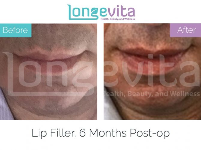 lip fillers turkey before after 6 670x500 1
