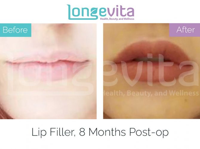 lip fillers turkey before after 7 670x500 1