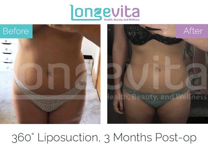 liposuction turkey before and after 4 670x500 1