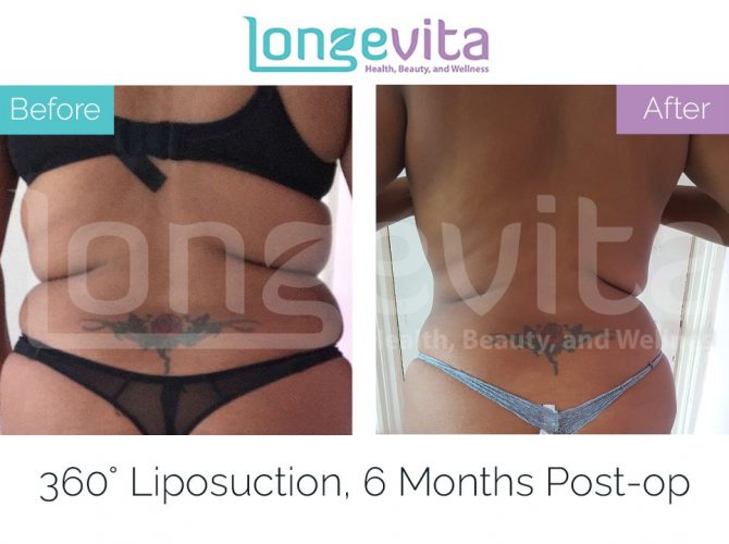 liposuction turkey before and after 7 670x500 1
