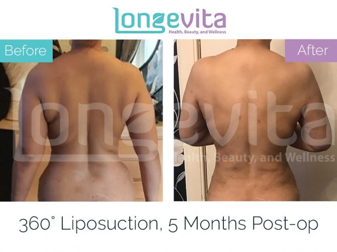 liposuction turkey before and after 8 670x500 1