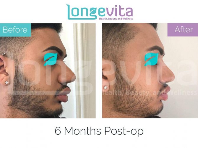 nose job before and after male 2 670x500 1