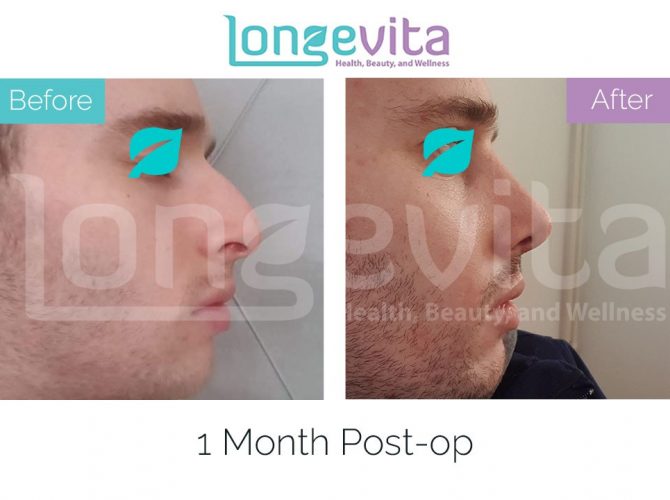 nose job before and after male 20 670x500 1