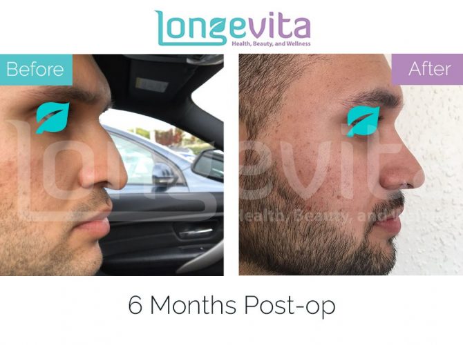 nose job before and after male 6 670x500 1