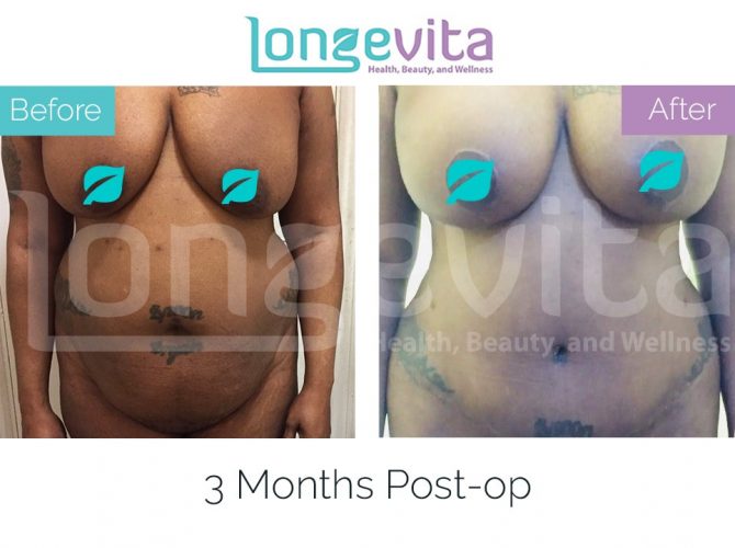 tummy tuck turkey before after 3 670x500 1
