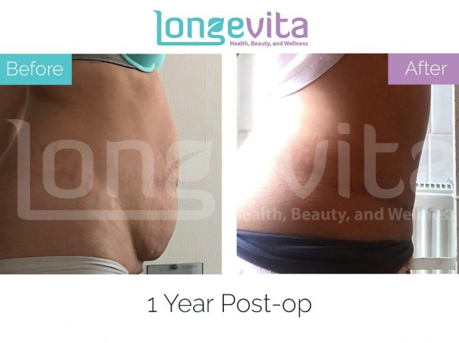 tummy tuck turkey before after 4 670x500 1