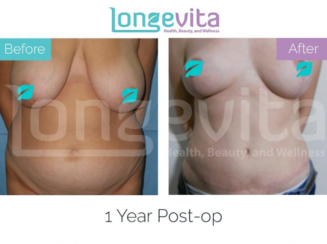 tummy tuck turkey before after 7 670x500 1