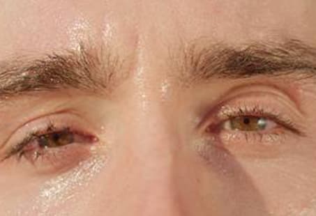 excessive sweating