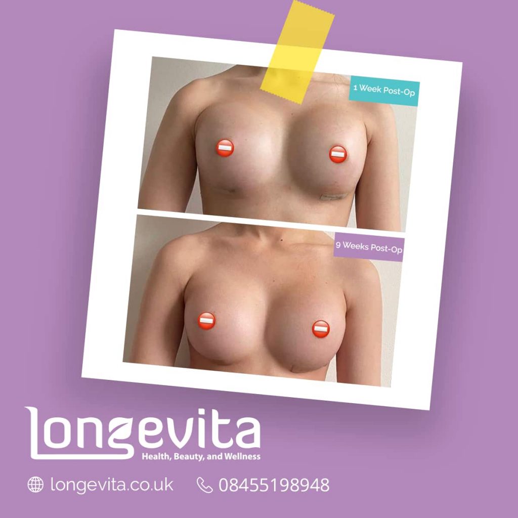 swelling after breast augmentation