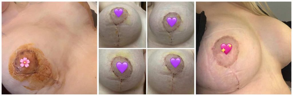 healing process of boob job