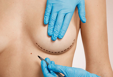 Auto-augmentation breast lift