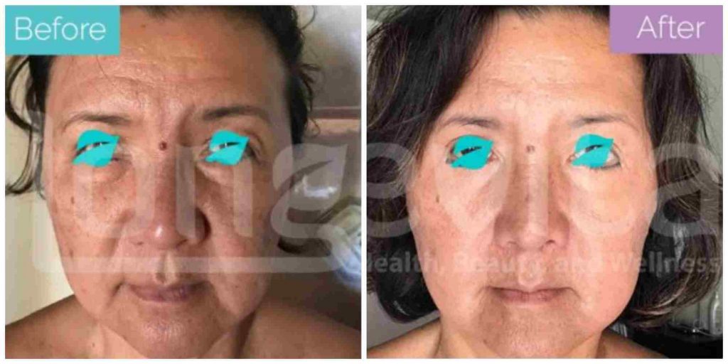 Eyelid and Facelift before and after