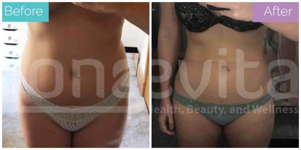 liposuction before and after