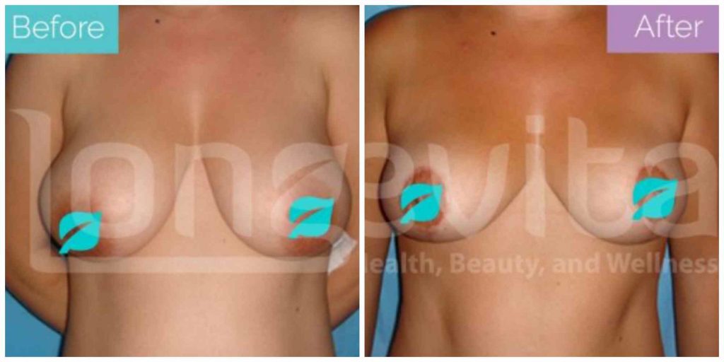 Breast lift before and after