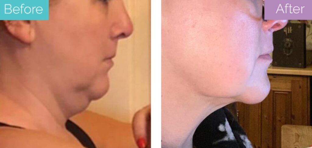 Chin vaser lipo