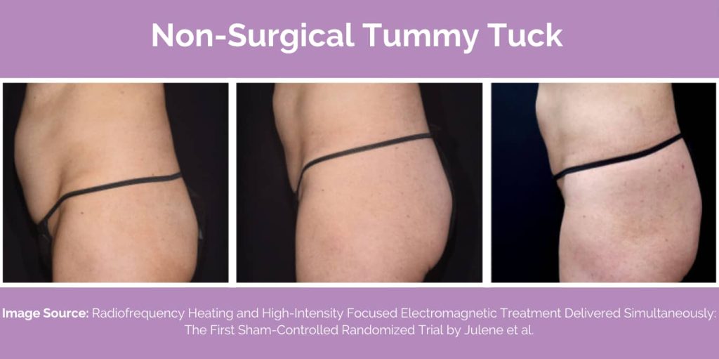 Non surgical tummy tuck results