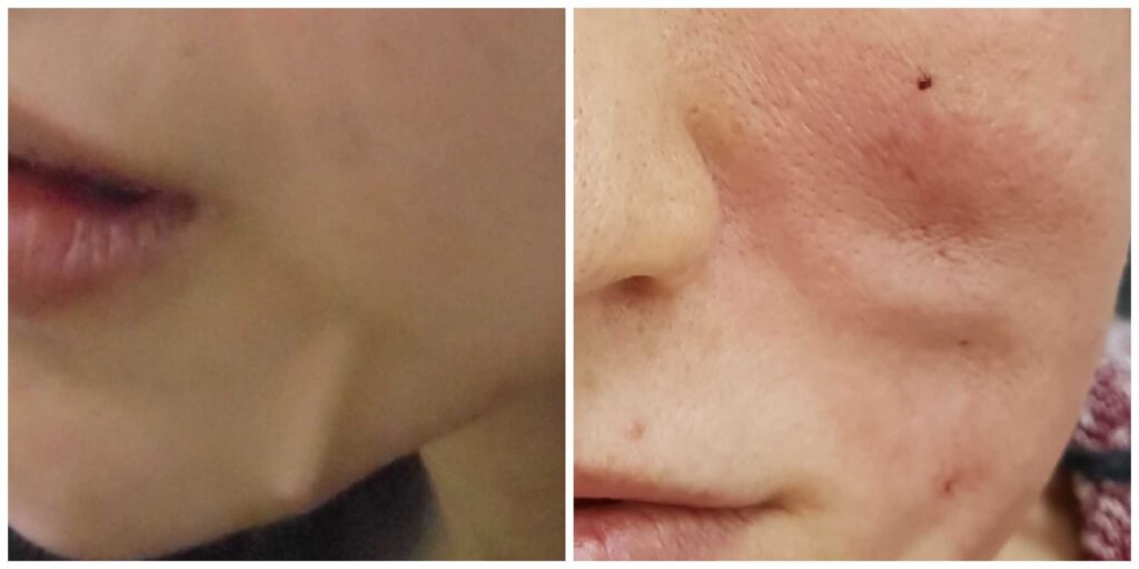 Potential complications of nose thread lift