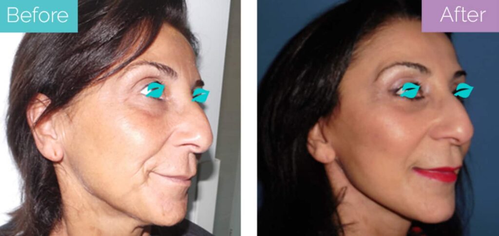 Surgical facelift before and after