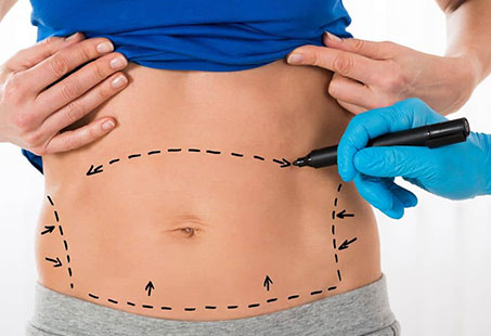 Vaser liposuction