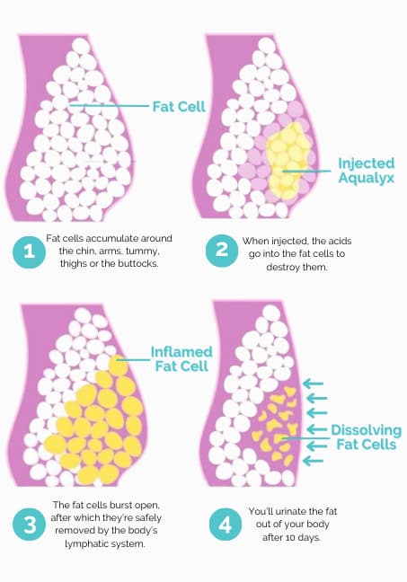 fat dissolving injection procedure