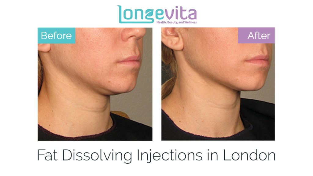 fat dissolving injections in london