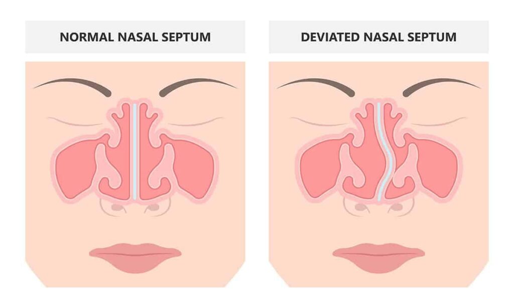 Deviated septum crooked nose