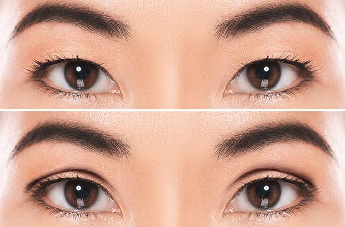Double eyelid surgery before and after