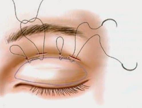 Double eyelid surgery non incision method