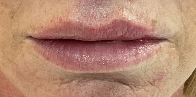 Lip filler swelling